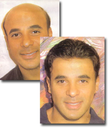 tratamento queda de cabelo masculino